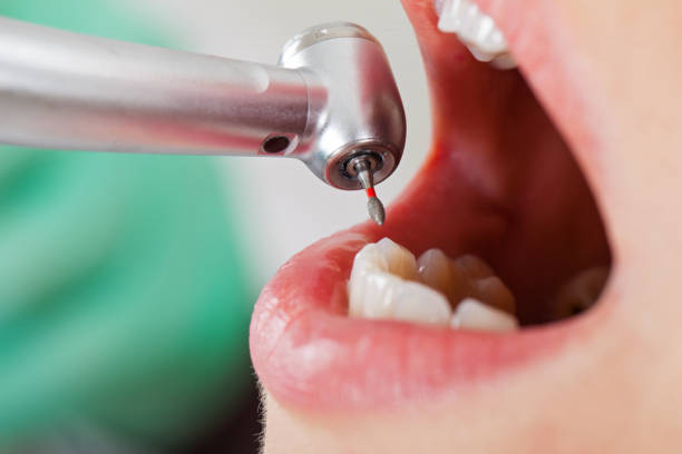 Best Emergency Tooth Extraction  in Burlington, KY